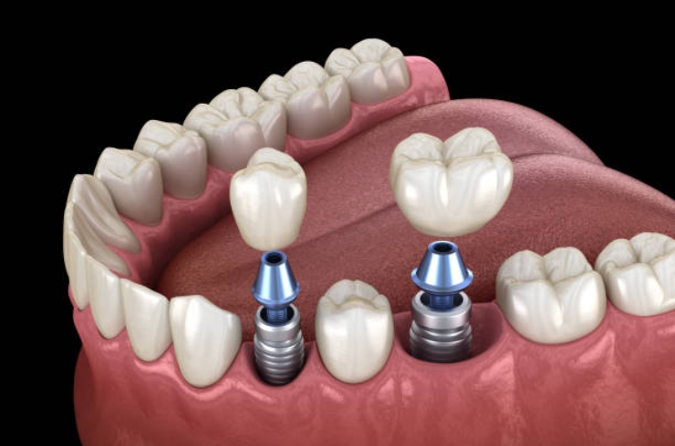Dental Implant Fixing------13