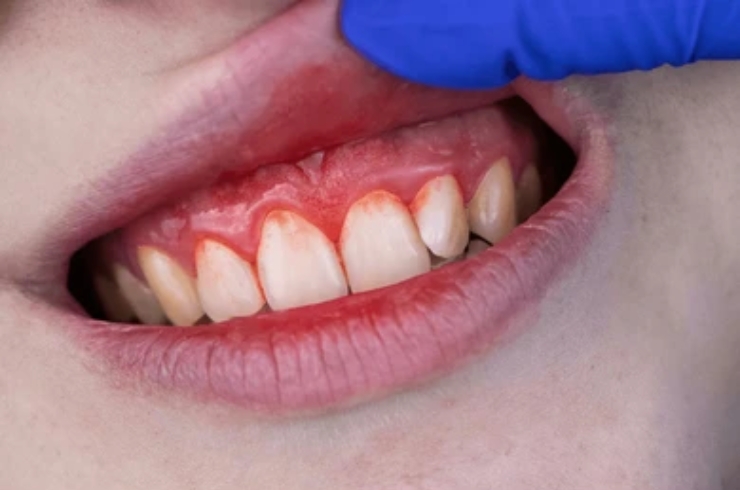 Gum Disease Treatment-----12